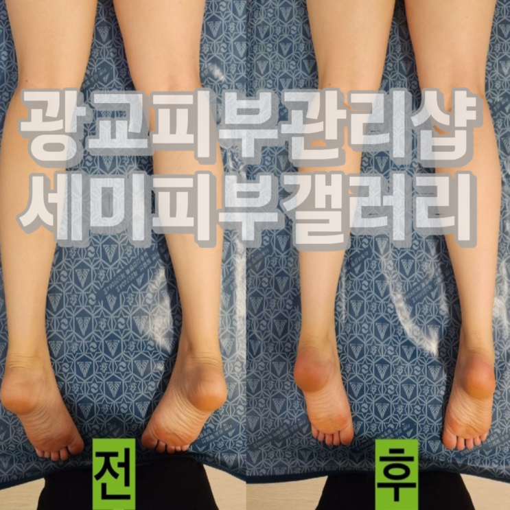  광교피부관리샵 세미피부갤러리에서 하이웨스트 하체관리 후기