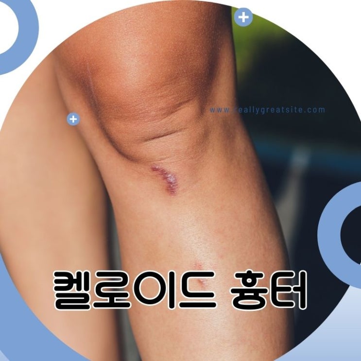  켈로이드 흉터 치료법