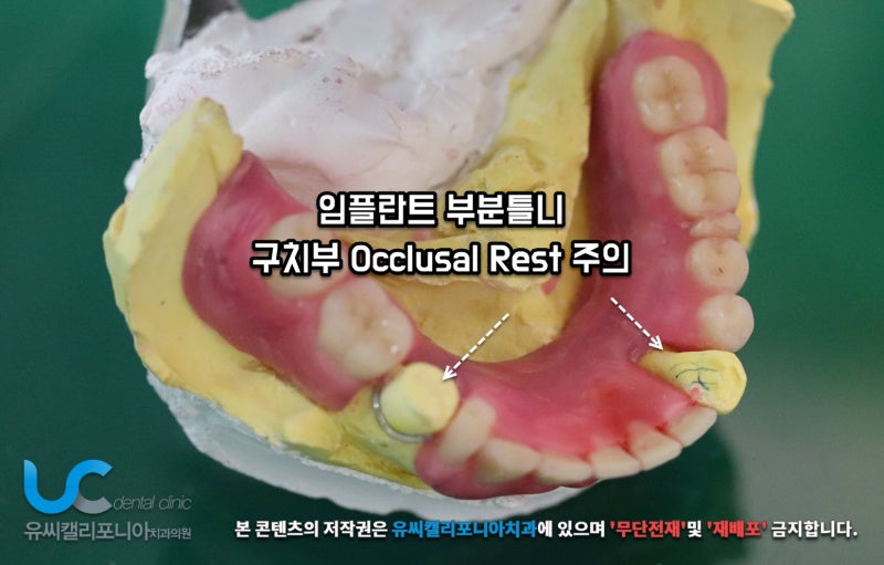 임플란트 부분틀니 치료방법