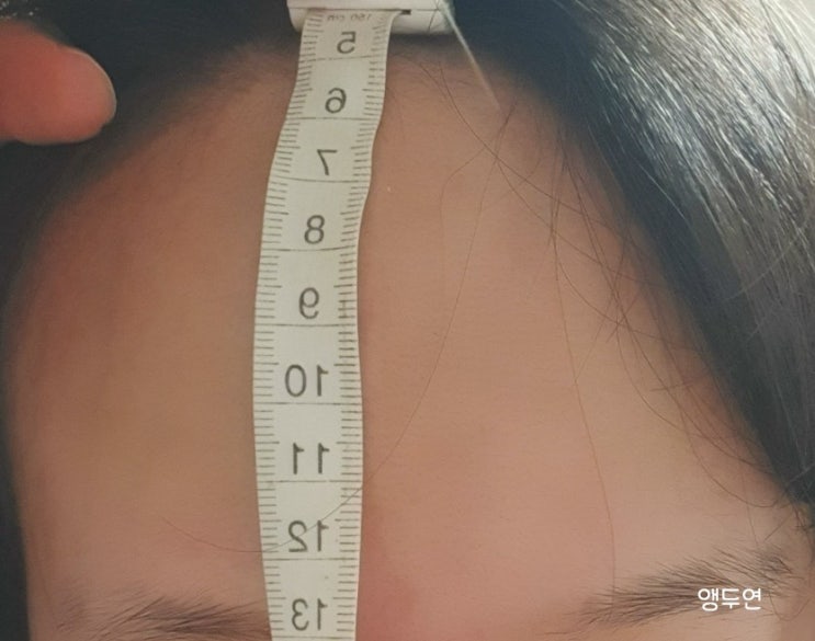 이마축소술 후기 ㅣ 부작용 ㅣ3년 3개월 경과 이마축소술 후기 ㅣ 부작용 ㅣ3년 3개월 경과