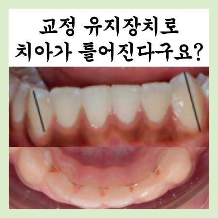  교정 유지장치로 치아가 틀어질 수 있을까?