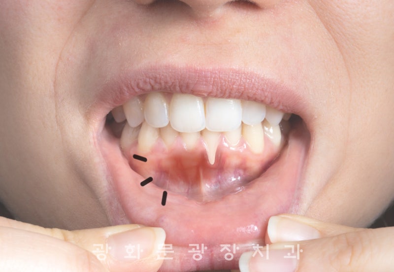 잇몸 피고임, 피고름, 피물집 생기는 원인 및 예방법