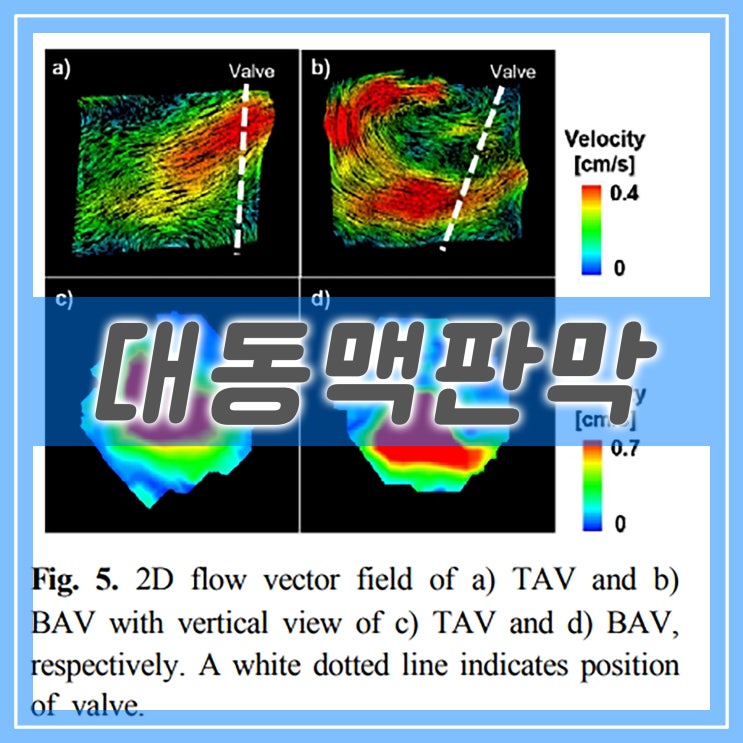  대동맥판막 협착증, 4차원 자기공명영상을 활용한 돼지 심장 ex-vivo 이첨판 모델 유동 분석