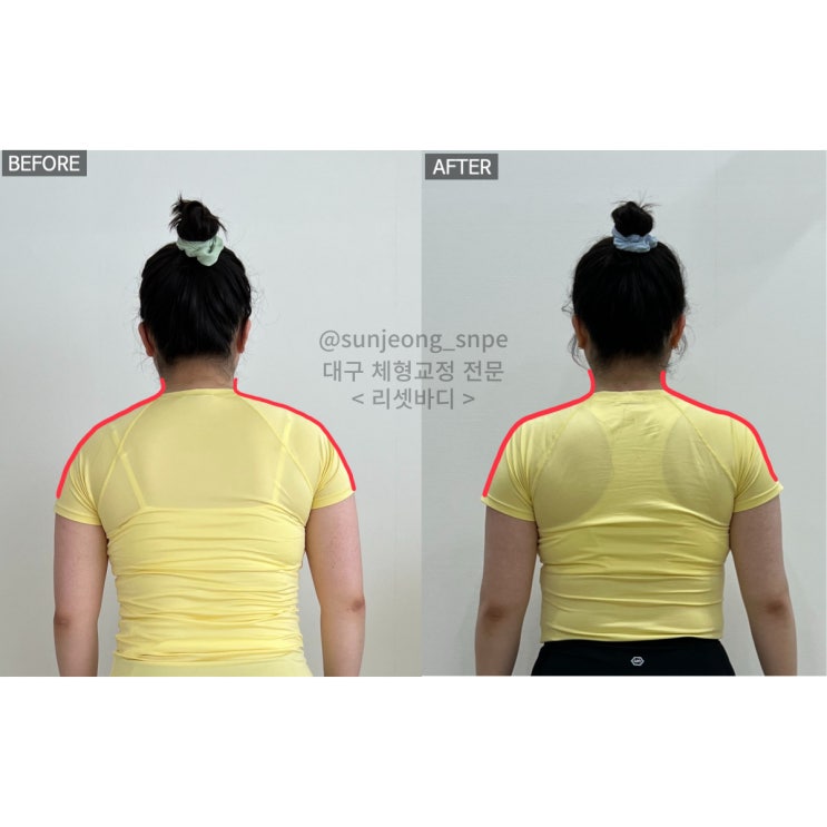  [대구SNPE 리셋바디] 거북목,라운드숄더,만성두통,골반교정 모두 리셋바디에서 해결 !