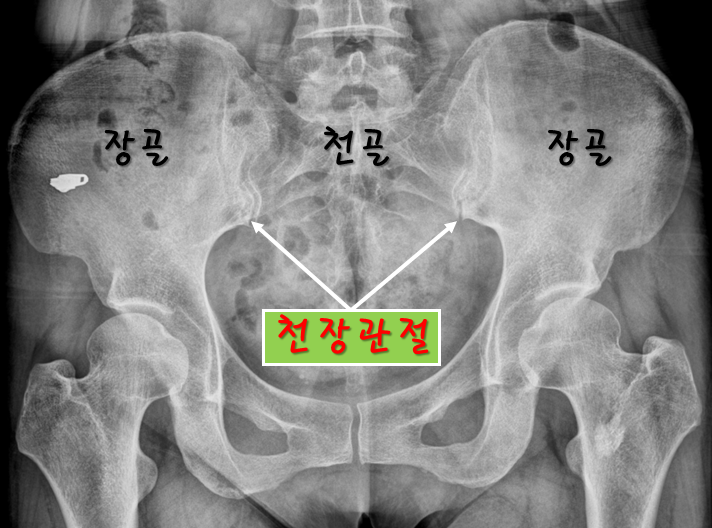  천장관절염, 치료했지만 차도가 전혀 없던 이유