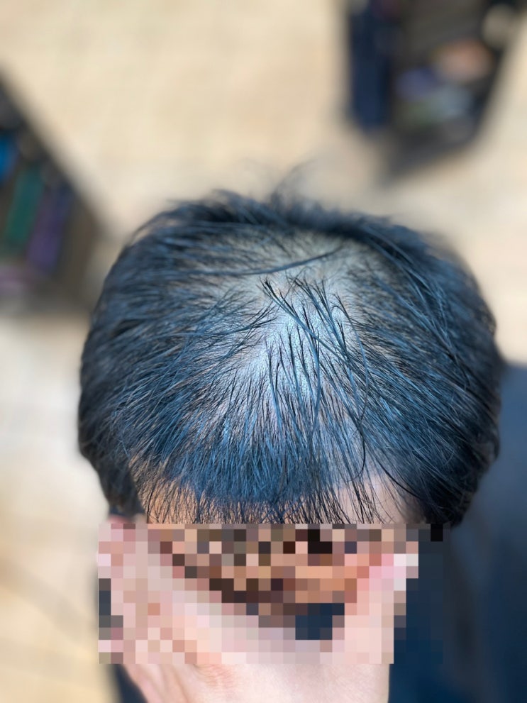  실패한 두피 문신 히든 탈모 펌으로커버와 볼륨까지부산사상르네시떼6층미용실/당감초량부전양정연산서면감전주례망미수영학장하단거제명지녹산장유김해해운대반송금정장전동래사직온천명륜가야울산양산밀양
