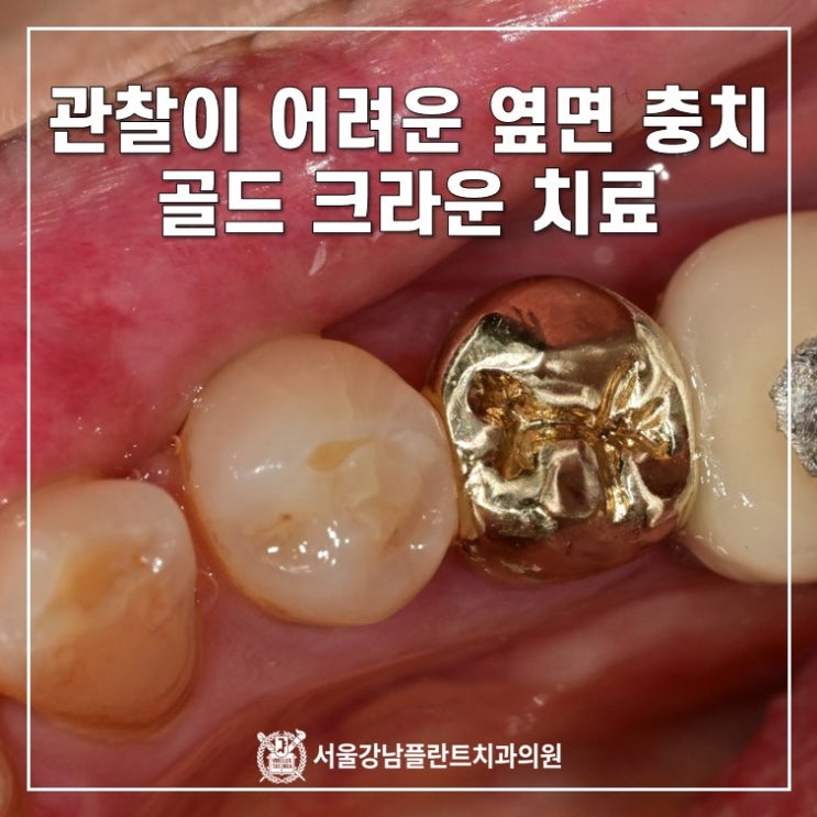 관찰이 어려운 옆면 충치 - 골드크라운 치료