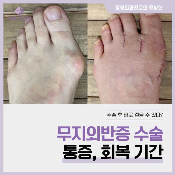  [족부전문의 류창현] 무지외반증 수술 후 다음날부터 바로 걸을 수 있다? ｜ 통증 및 회복기간