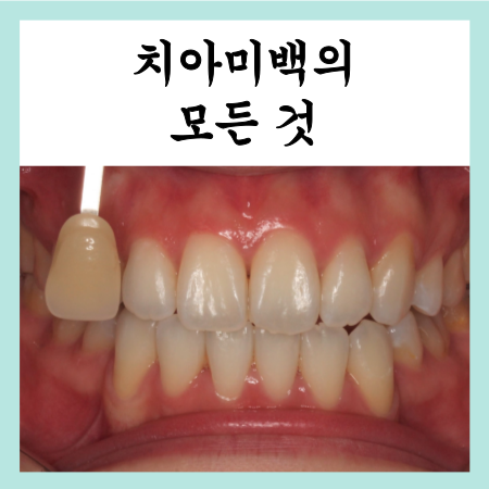  치아미백의 방법과 장단점에 대해서