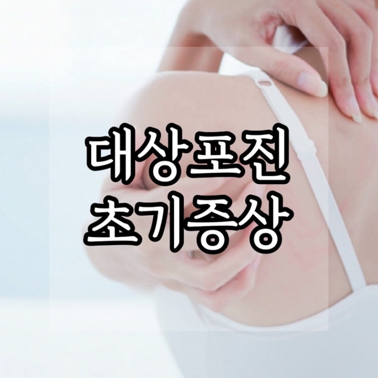  대상포진 초기증상 치료방법 알아보자