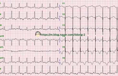  Hypokalemia (저칼륨혈증) Hypomagnesemia (저마그네슘혈증) EKG T wave inversion