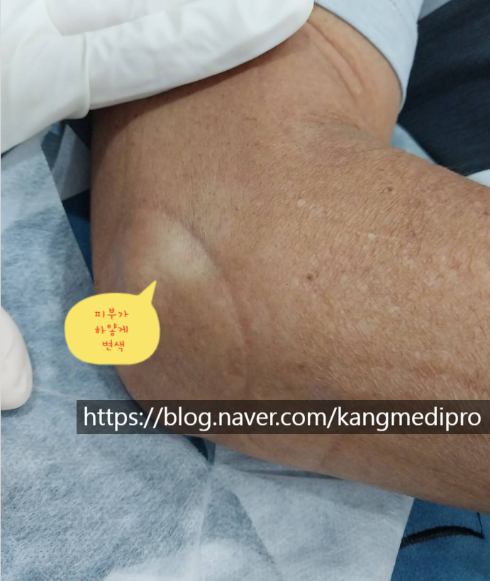  테니스 엘보우, 적어도 스테로이드 주사는 맞지 마세요 (부산)