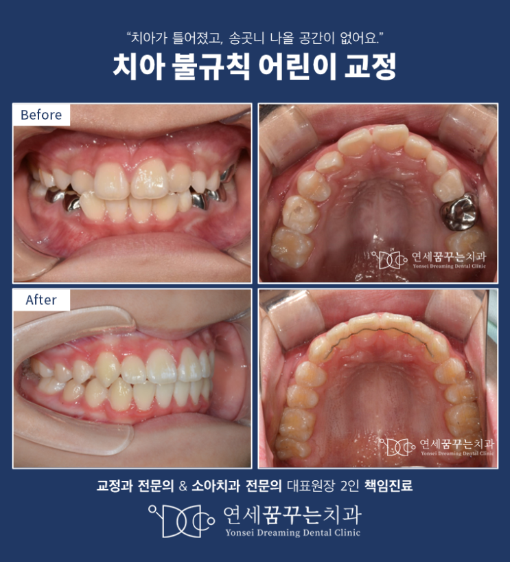 송곳니 공간이 없어요. 어린이 교정으로 발치 없이(비발치) 해결하기!