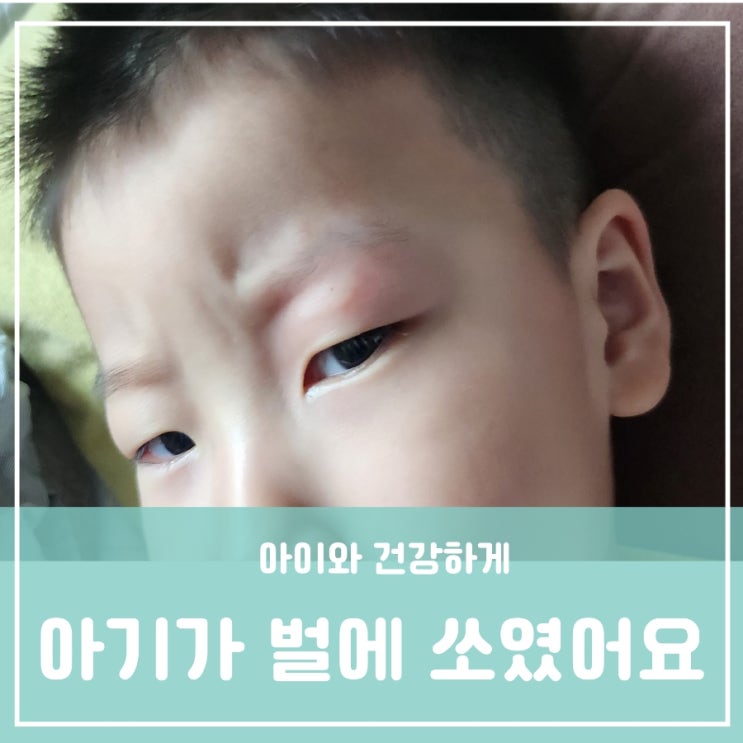 아이가 벌에 쏘였을 때 원인 증상 치료 벌의 종류 아이가 벌에 쏘였을 때 원인 증상 치료 벌의 종류