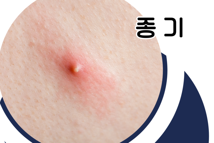  종기가 자꾸 나는 원인 치료법
