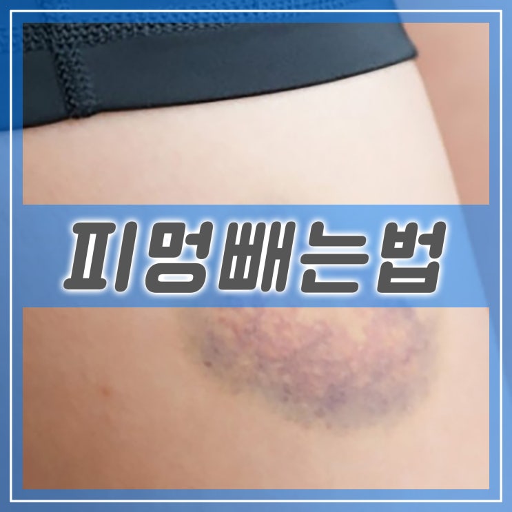  피멍 빼는법, 피멍 생기는 이유와 관리하는 방법
