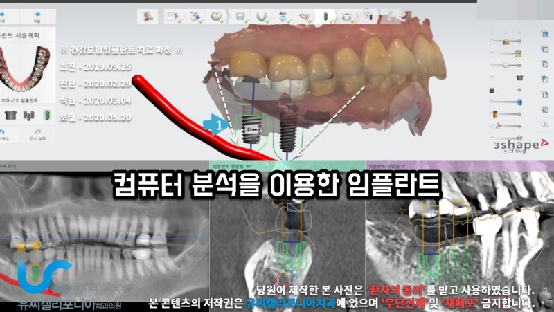 임플란트 지지과정을 비교하고 확인해보세요