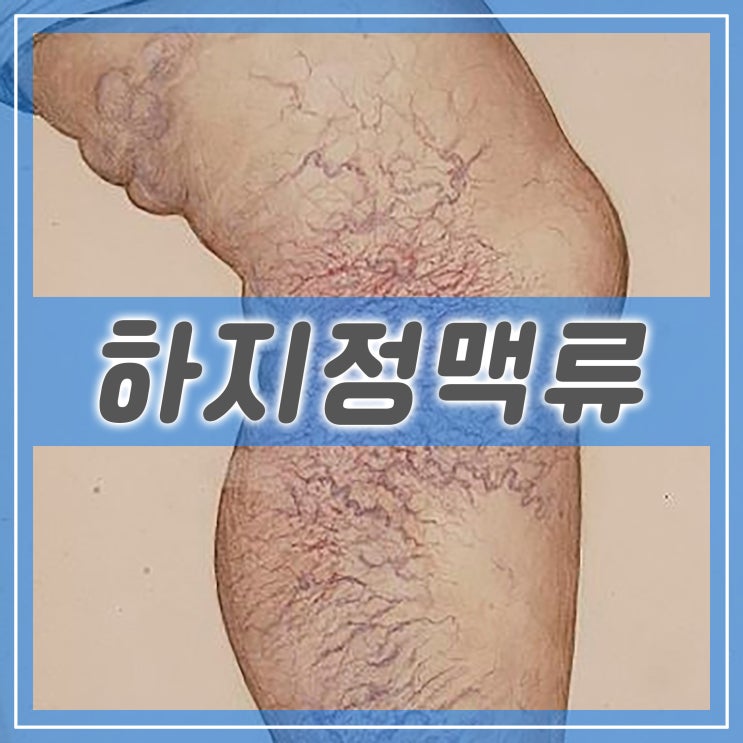  하지정맥류 약, 센시아정 효능 가격 부작용 정보와 하지정맥류 초기증상과 원인