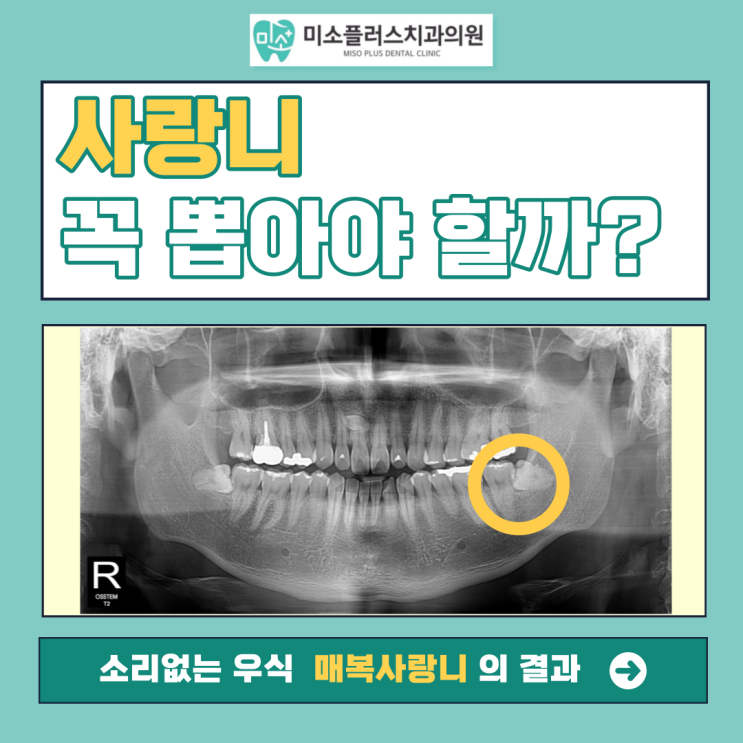  서정리역 치과 평택고덕치과/사랑니 왜 뽑아야 할까요?