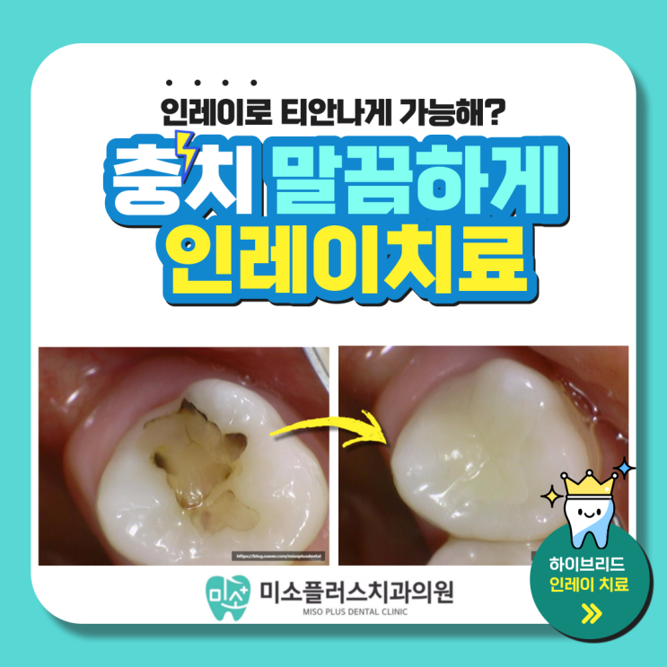  서정리역 치과 평택고덕치과/인레이치료2