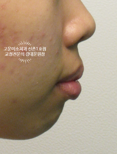  거미스마일과 입술돌출이 심하고 위턱이 나오고 아래턱이 짧은 2급 부정교합치료증례 신촌교정치과 고운미소 신촌1호점 치료증례