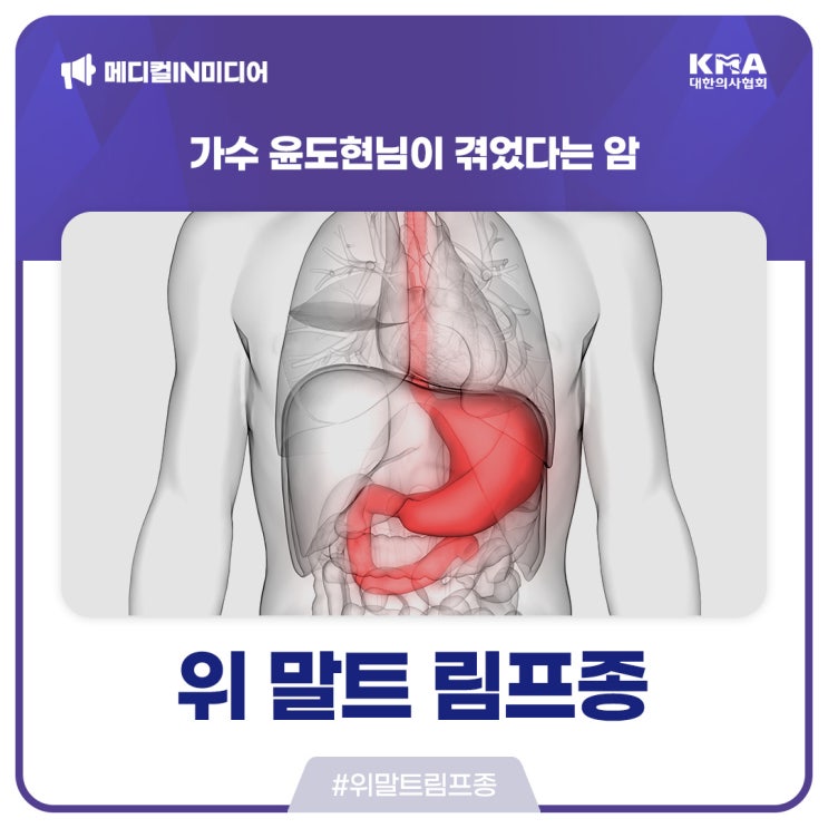  [메디컬 IN 미디어] 가수 윤도현님이 겪었다는 위 말트 림프종은 어떤 병일까?
