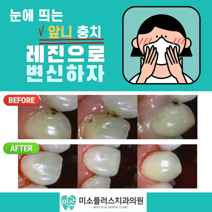  서정리역 치과 평택고덕치과/앞니 레진치료2