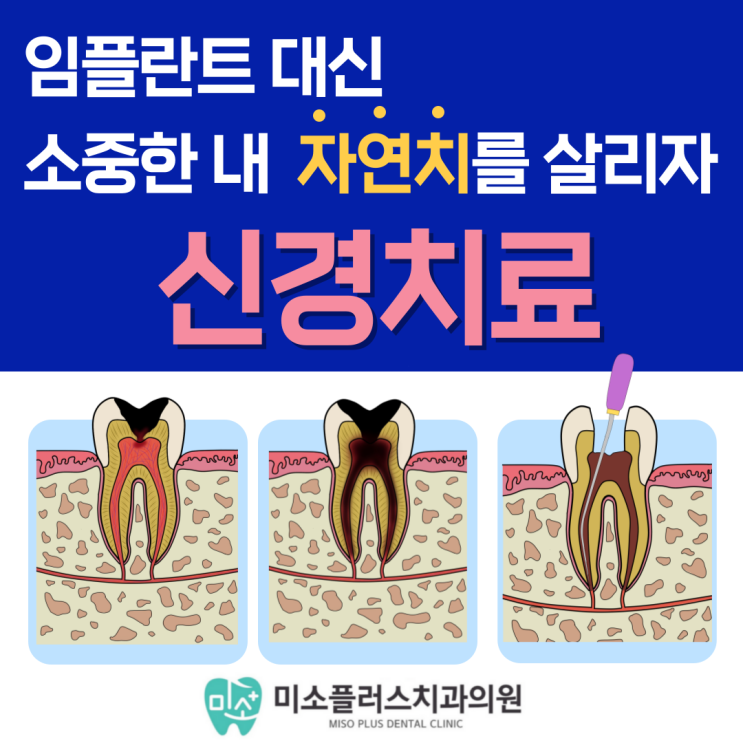  서정리역 치과 평택고덕치과/신경치료