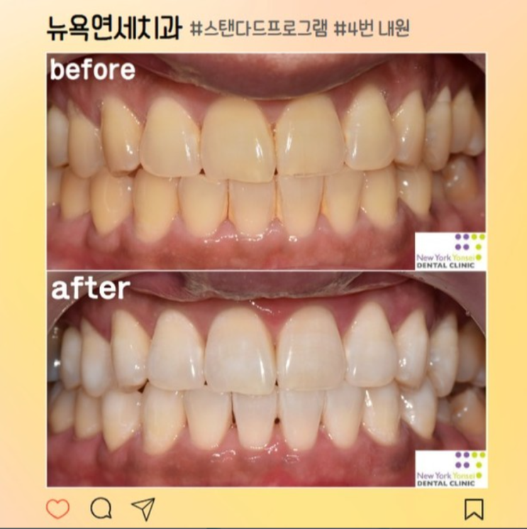 [강남역 치과] 안전한 치과 치아미백 효과 본 후기!(비용/전후 사진)