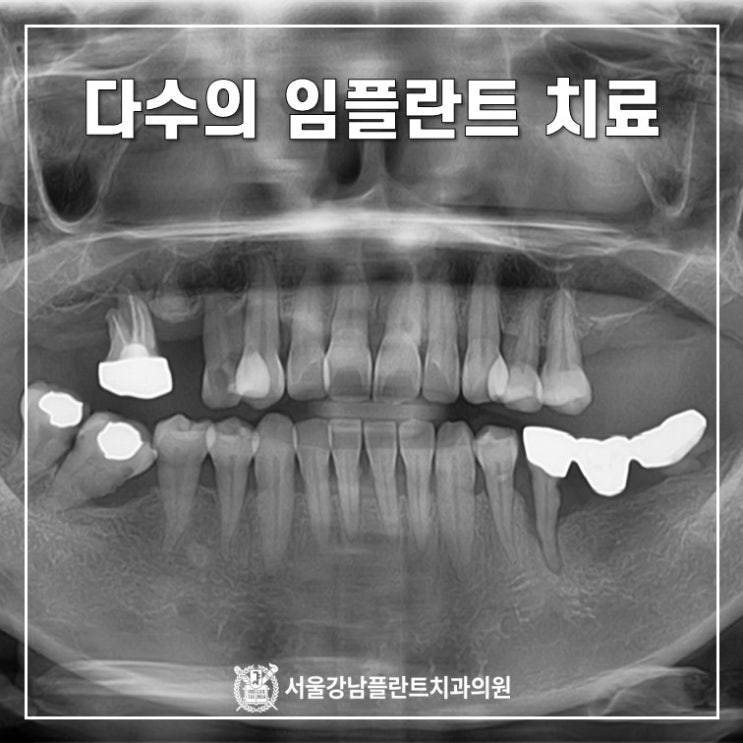  충치와 치주염, 치아쓰러짐 복합 치료 (feat. 다수의 임플란트)
