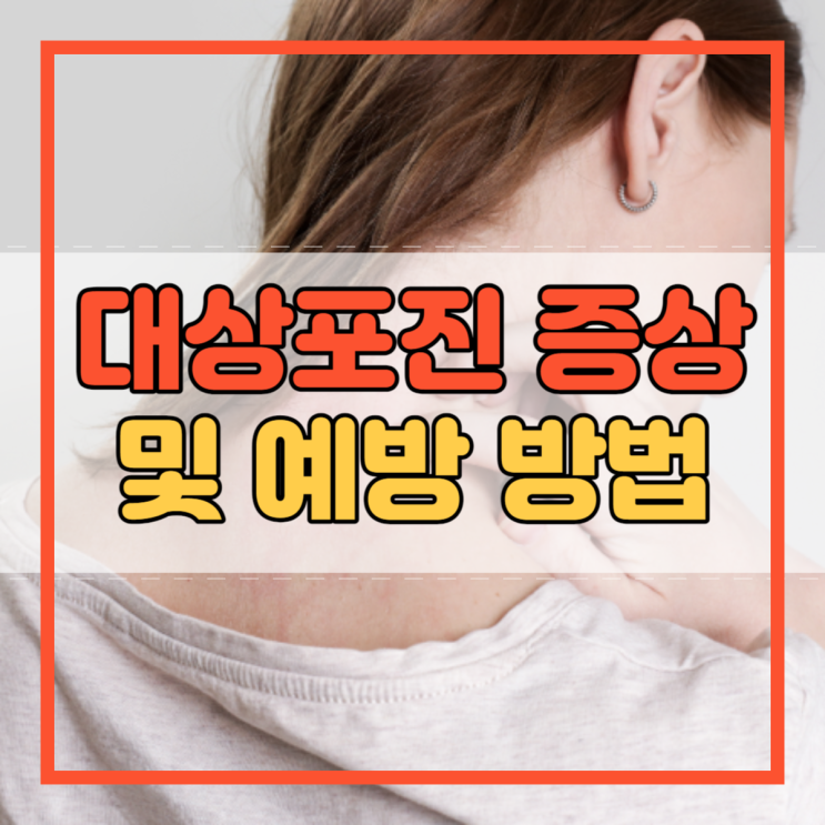  대상포진 증상 수두 바이러스 무엇이며 예방 방법은?