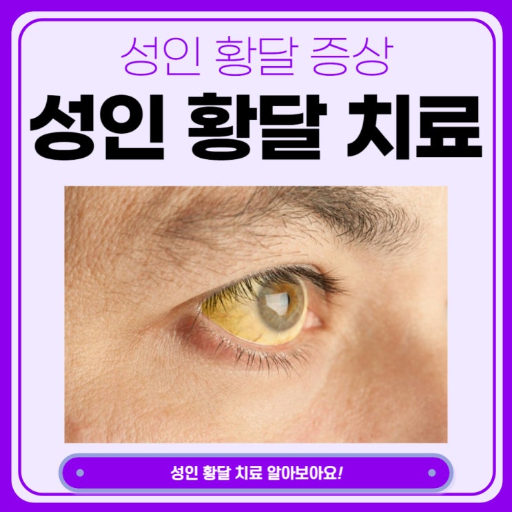  성인 황달 치료와 증상 알아보아요.