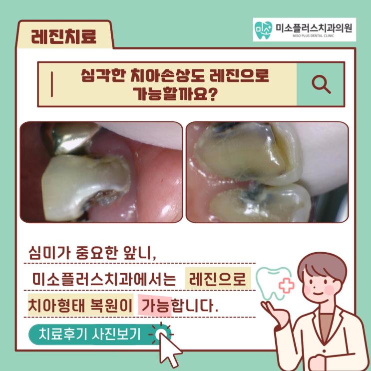  서정리역 치과 평택고덕치과/앞니 레진치료3