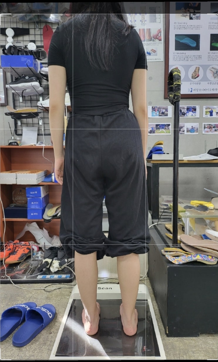  성장기 척추 측만증, 맞춤 깔창 교정 전과 후 정렬 변화