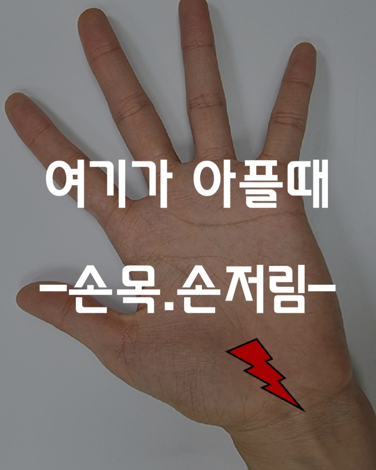 [재활의학과] 손목통증, 손이 저릴때 -1- (손목터널증후군)