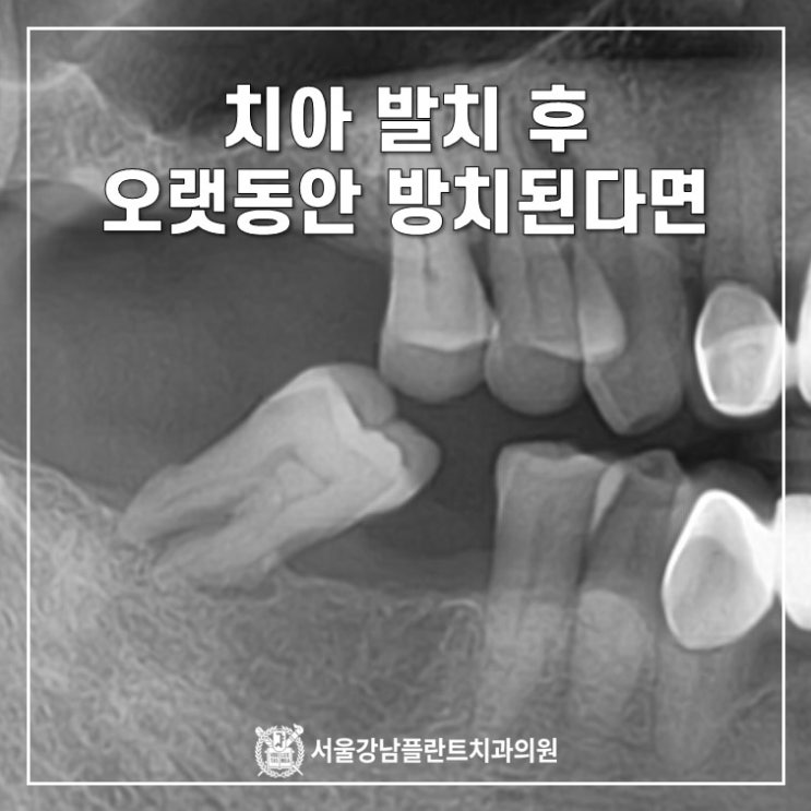  치아 발치 후, 오랫동안 빈공간을 방치한다면..(feat. 치아 쓰러짐, 치아정출)