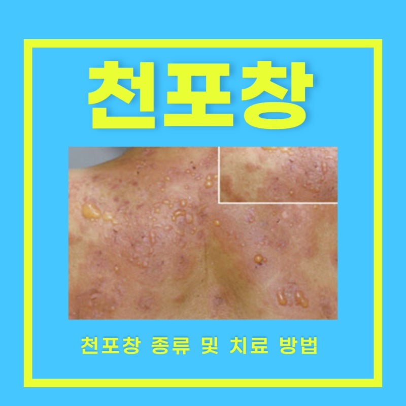 천포창 치료 방법 천포창 종류 낙엽 천포창 증상