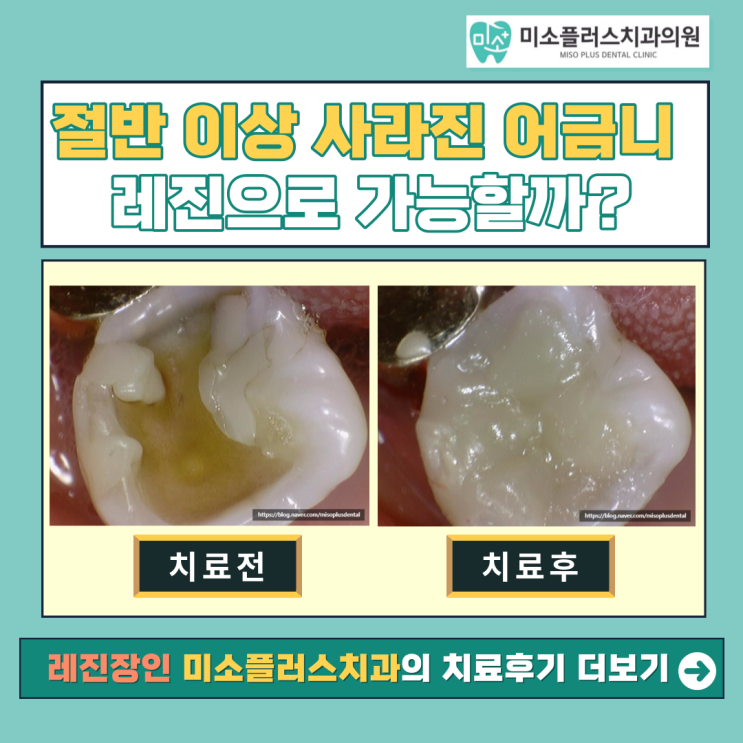  서정리역 평택고덕치과/어금니 레진치료