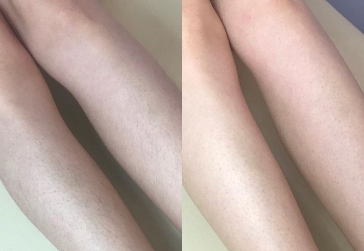  청주왁싱 확실하게 관리하는 제모 전문 온리제이