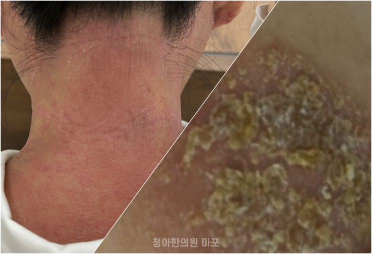 아토피 한약 먹어도 그때뿐인가요?