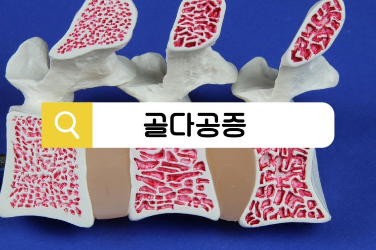  골다공증 자가 진단