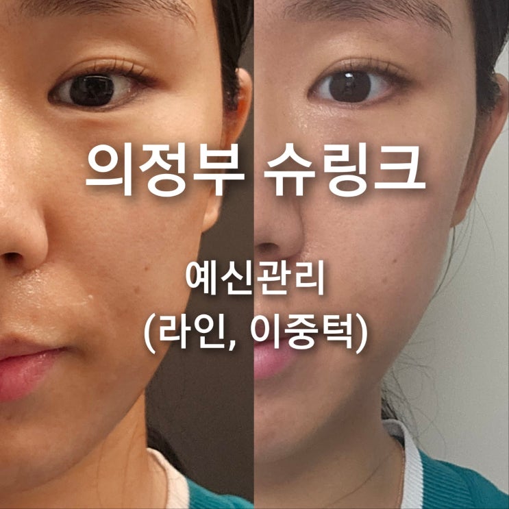  의정부 슈링크유니버스 300샷 얼굴 리프팅, 팔자주름, 이중턱 관리 (예신 관리 추천, 충격의 전후사진)
