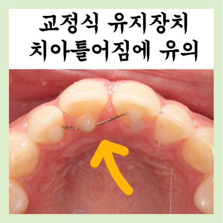  교정끝나고 고정식 유지장치, 치아틀어짐에 유의