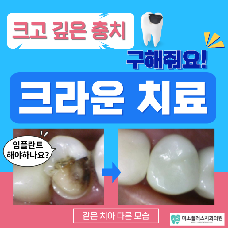  서정리역 치과 평택고덕치과/크라운치료