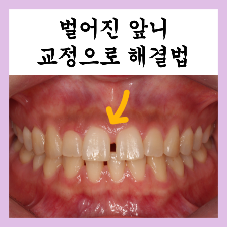  위아래 앞니 벌어짐, 하악 3전치일때 교정증례
