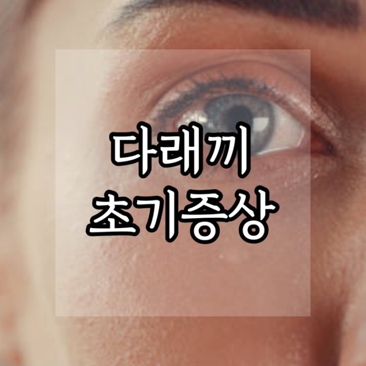  눈 다래끼 초기증상, 속다래끼 빨리 낫는법
