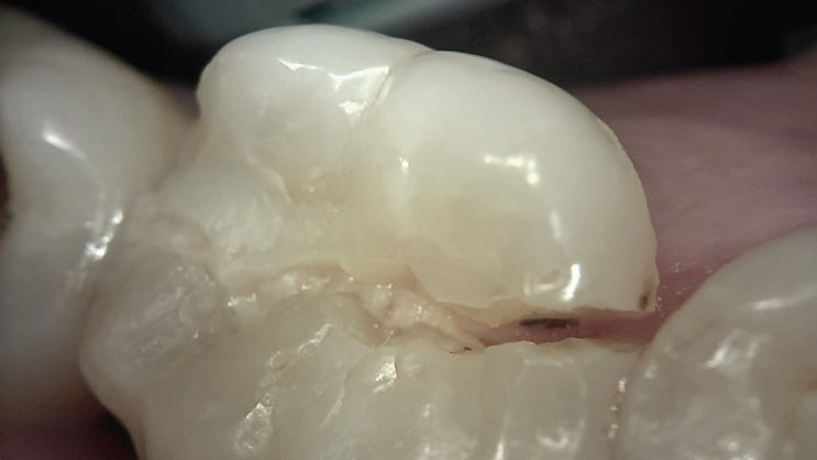 [임상] 크랙치아 /금이간 치아/ cracked tooth 치료 #1(1편)