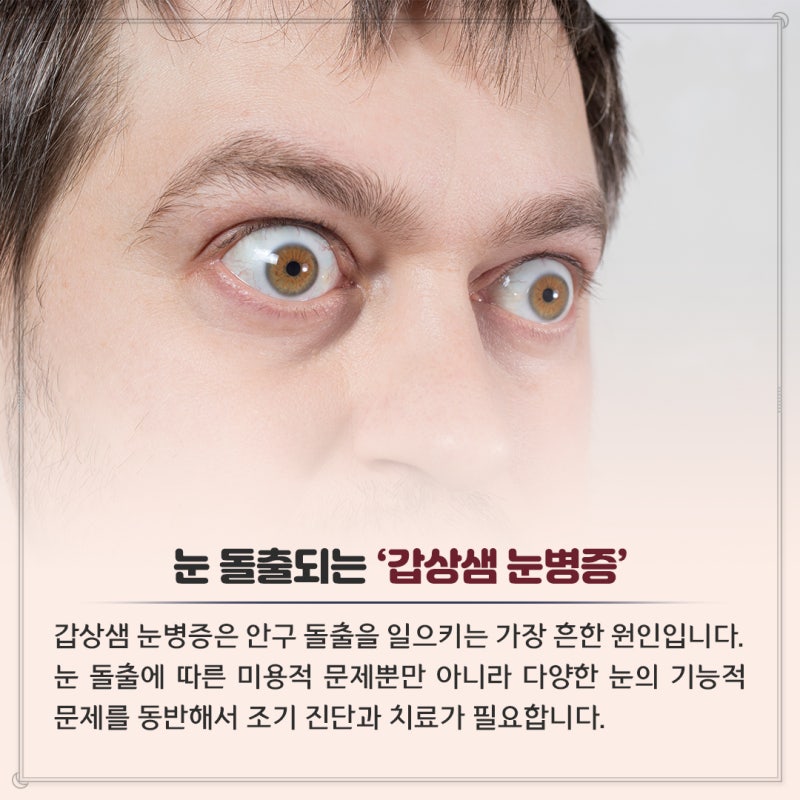 The eye protection method is to detect and treat thyroid eye protrusion as soon as possible!