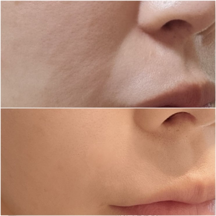 압구정피부과 팔자주름 쥬베룩볼륨 2cc 후기 (f.통증, 붓기)