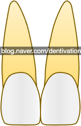 가운데 앞니 : 상악, 하악 중절치, central incisor - 치아형태 시리즈